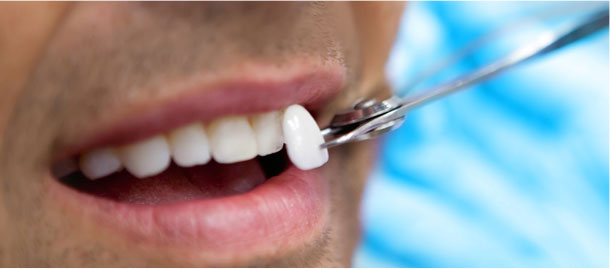 Estética dental en Girona