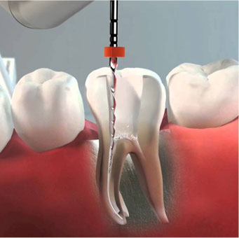 endodoncia a girona