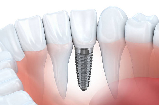 dentista implantologia a girona