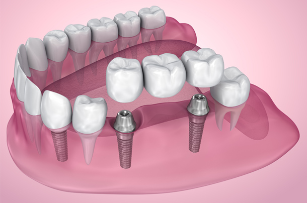 clinica dental implantologia a girona