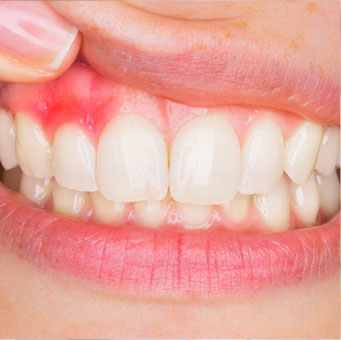 periodoncia oral a girona
