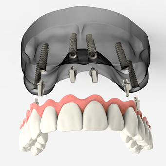 rehabilitació oral a girona